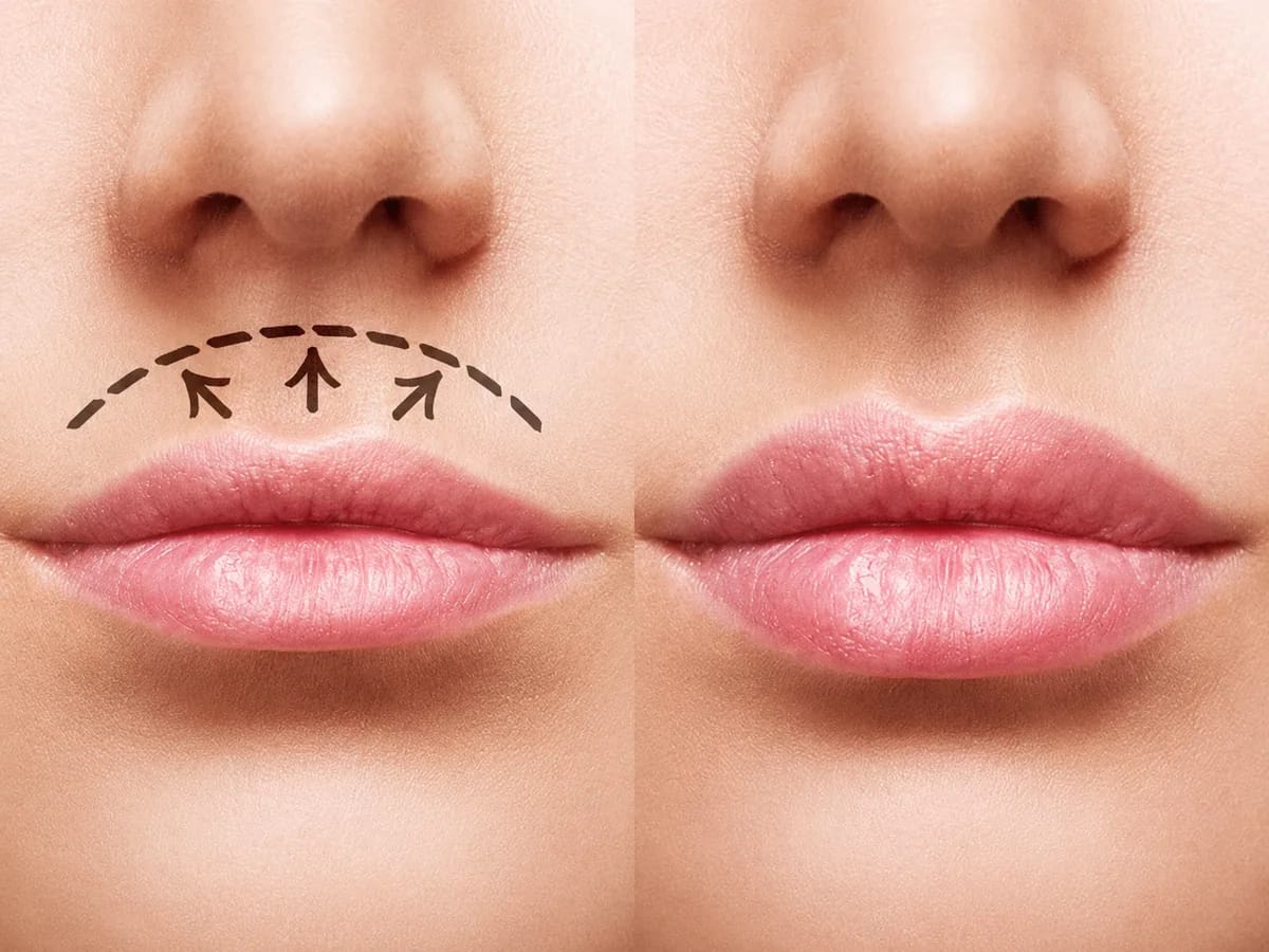 Lifting Labial